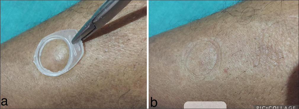 An innovative disposable ring for mucosal examination and pressure hemostasis