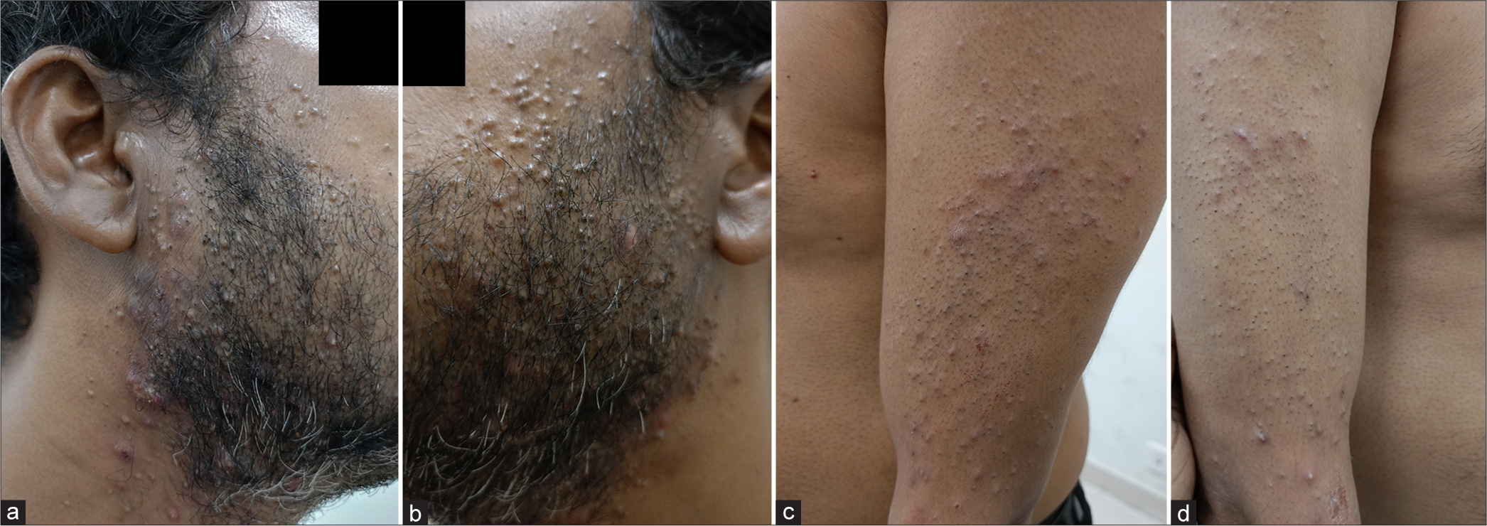 A resistant case of chloracne successfully treated with azithromycin pulse
