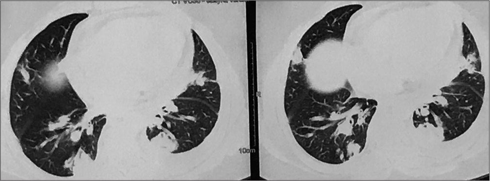 Granulomatosis with polyangiitis masquerading as disseminated tuberculosis in presence of bilateral lung cavities and hemorrhagic infarct