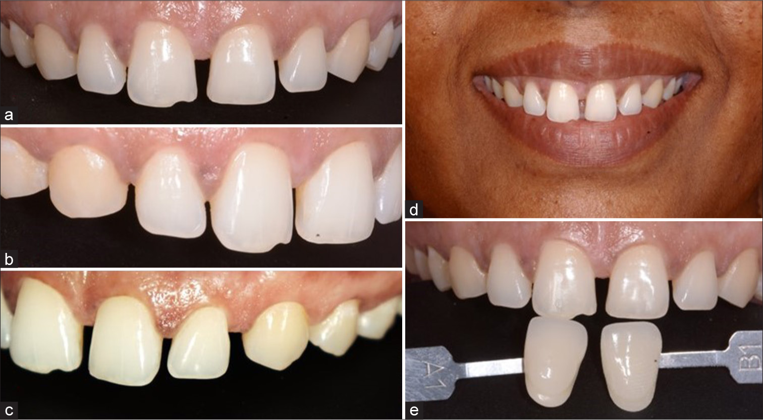 Multiple diastema closure with lithium disilicate veneers