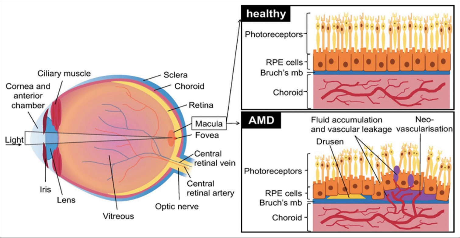 Stem cell treatment for dry AMD