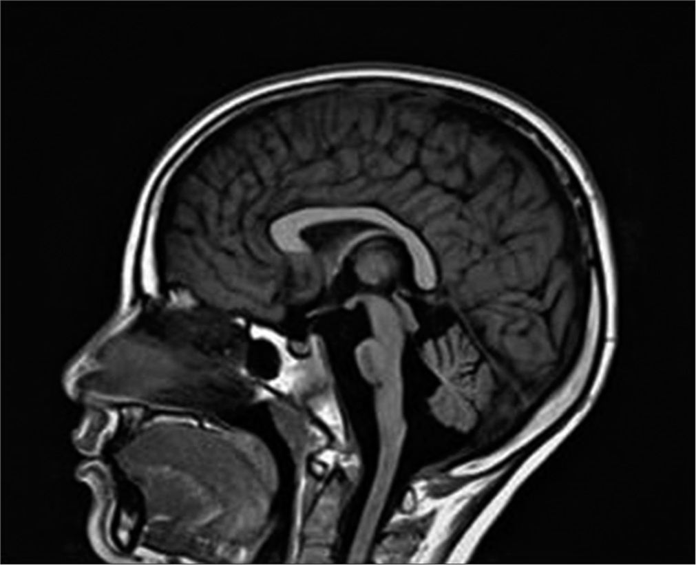 Early neurological association in a young child with Wolfram syndrome