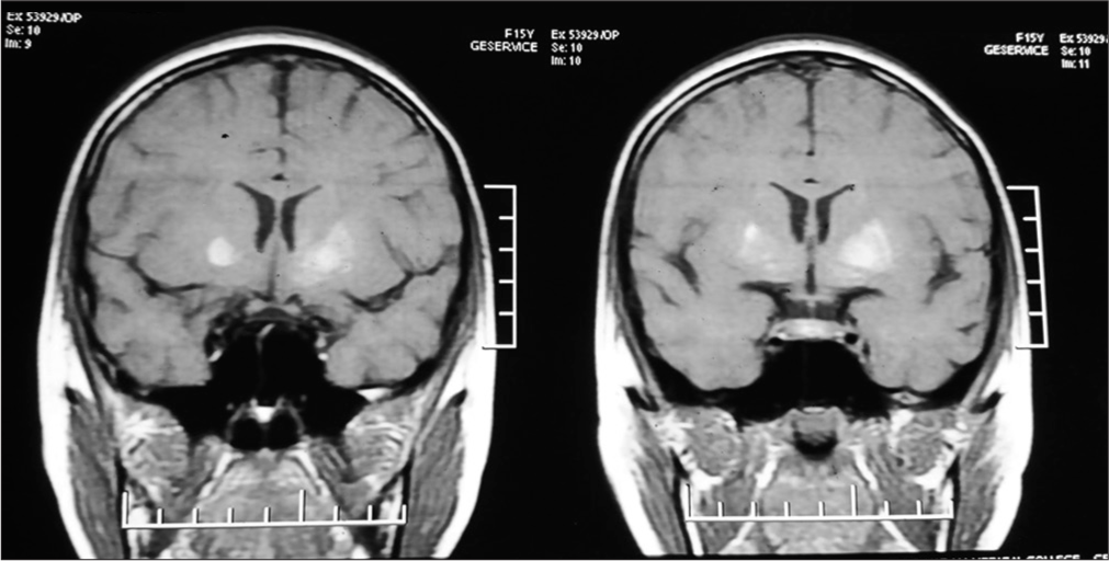 Diabetic striatopathy – A rare manifestation of type 1 diabetes in children – A case report