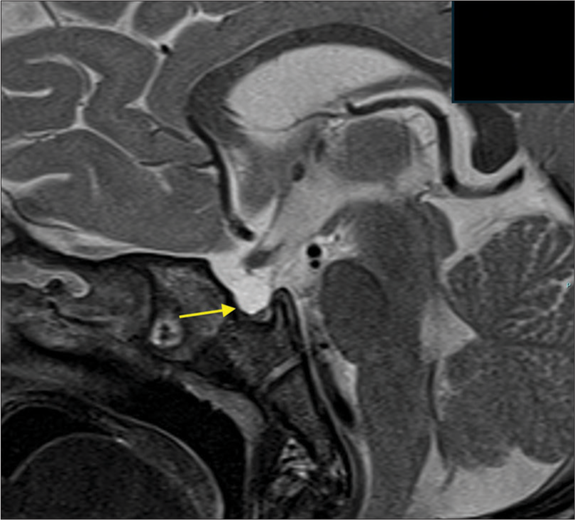 Hypopituitarism secondary to pediatric traumatic brain injury – A need for active vigilance