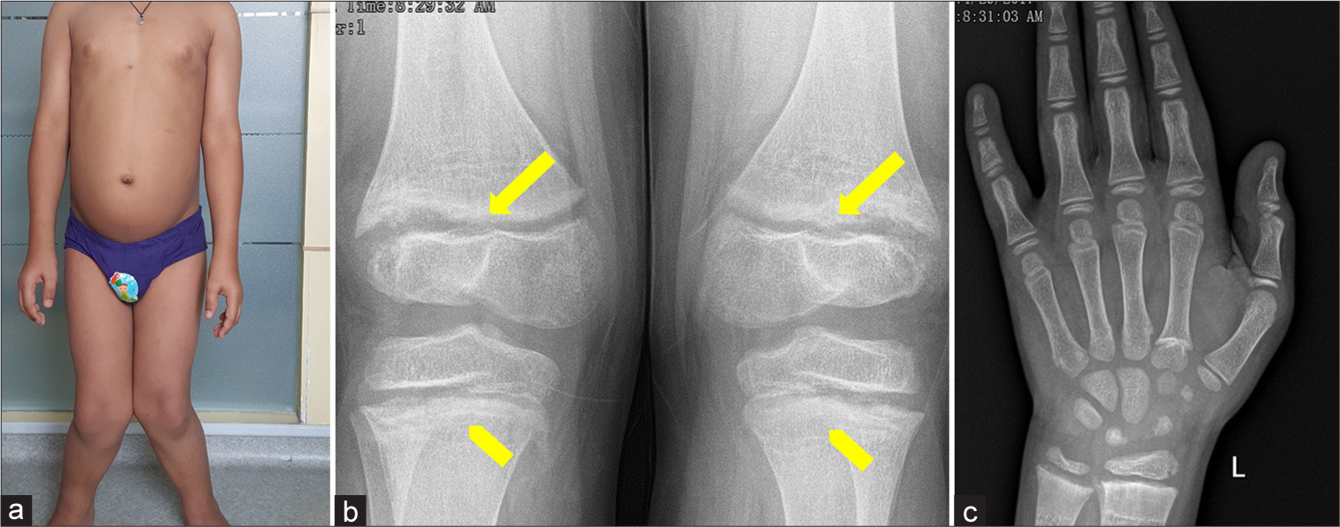 Dent disease type 2 due to OCRL1 mutation in a boy with rickets