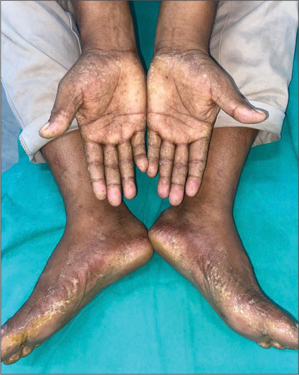 Dasatinib-induced hand foot syndrome followed by bosutinib-induced photoallergic contact dermatitis in a patient of chronic myeloid leukemia: A rare co-occurrence
