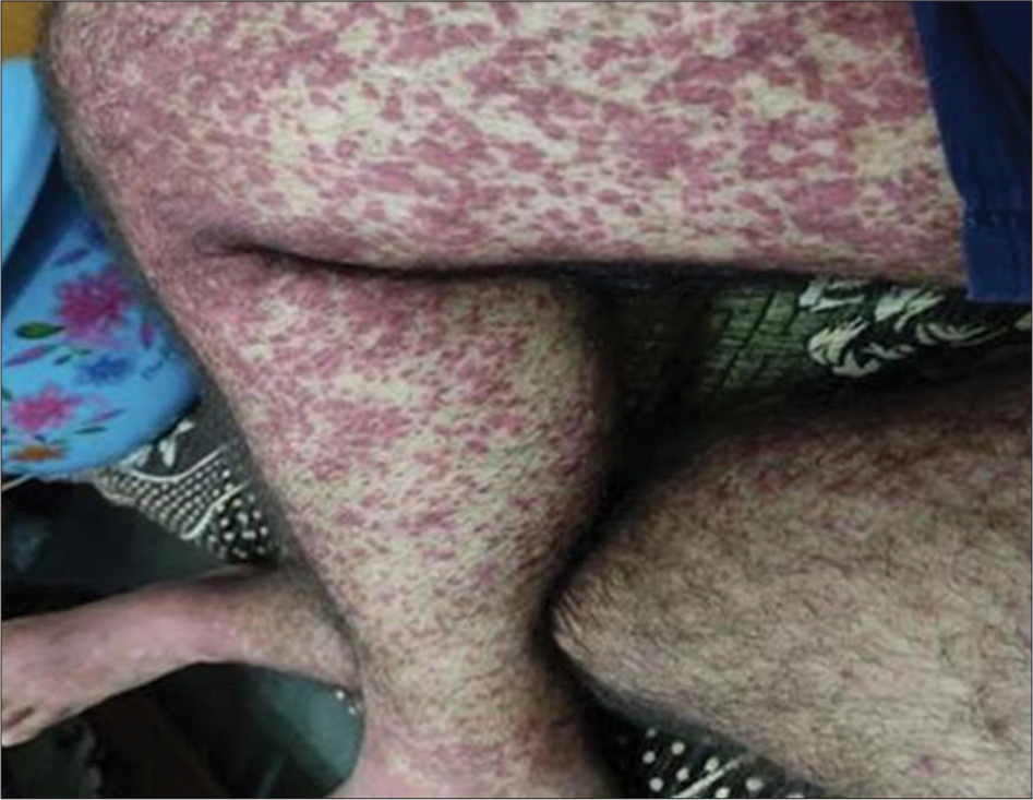 Ambroxol-induced leukocytoclastic vasculitis: A case report and literature review