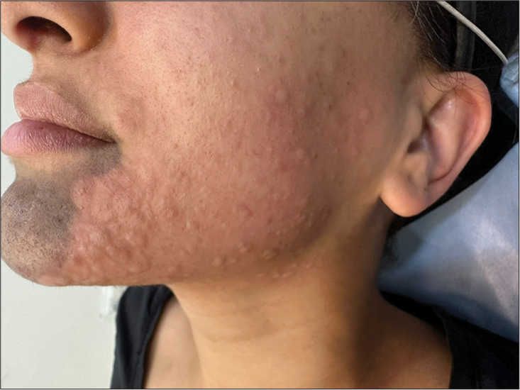 Inducible urticaria or skin lesions induced by Nd: YAG laser?