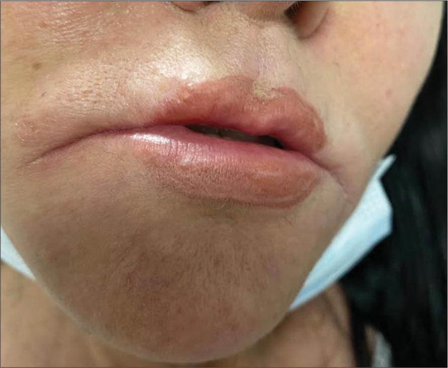 Homemade lip injection for cosmetic purpose: A case report