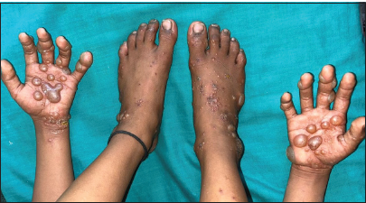 A rare presentation of pompholyx in a child mimicking bullous pemphigoid