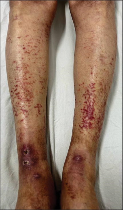 Cutaneous vasculitis as the sole clinical feature of primary Sjögren’s syndrome