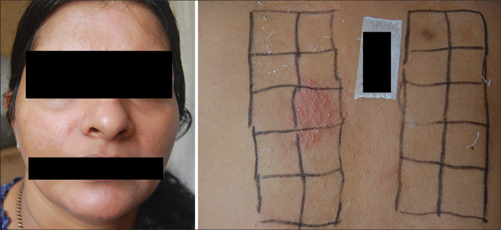 Patch testing with Indian standard series of 20 allergens in 125 patients of chronic dermatitis and dermatoses