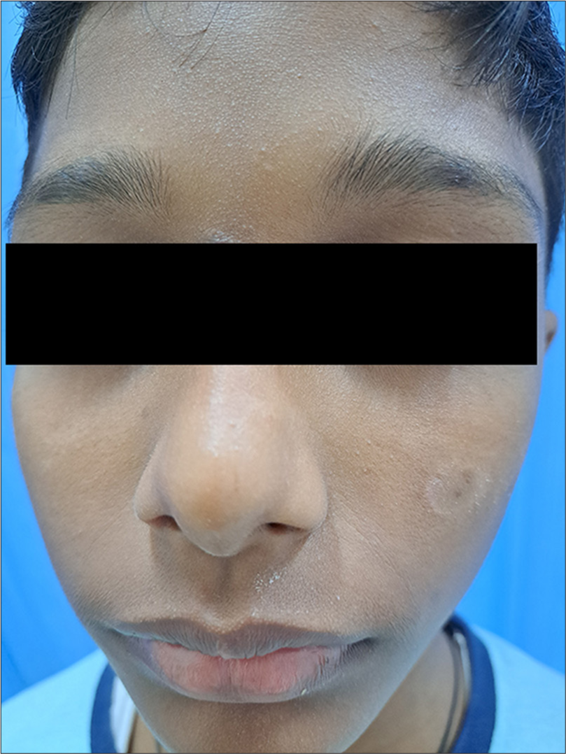 Allergic contact dermatitis in children with atopic cheilitis and eyelid dermatitis – A case series