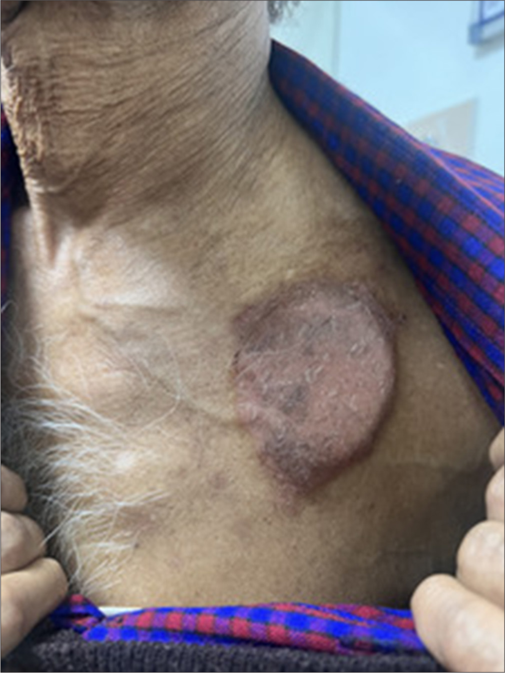 Pacemaker dermatitis – A rare hypersensitivity reaction