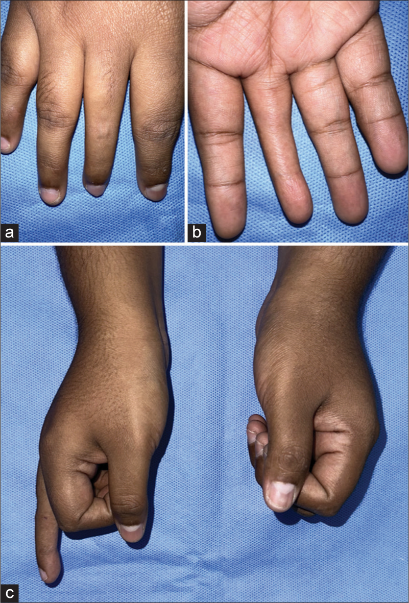 Congenital absence of flexor and extensor tendons in the middle finger: A rare disorder