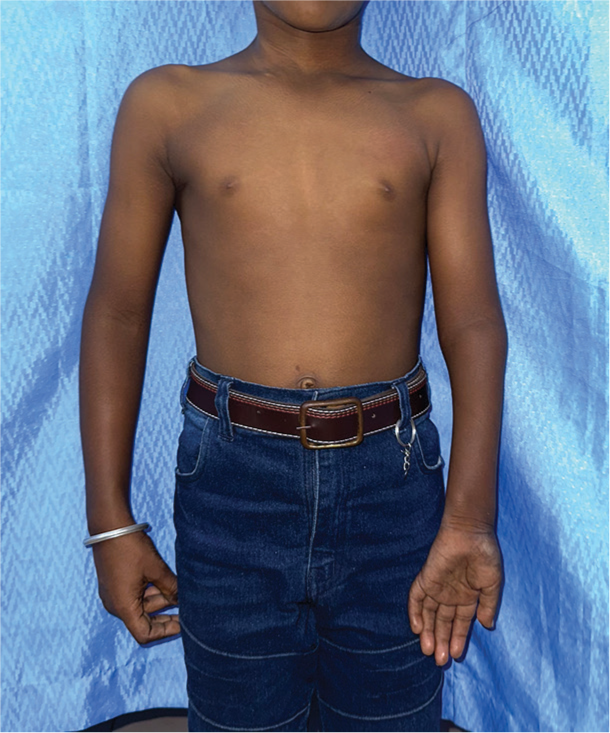 Complex forearm deformities in brachial plexus birth palsy: Radial head dislocation, forearm bones crossing, and distal ulna volar dislocation