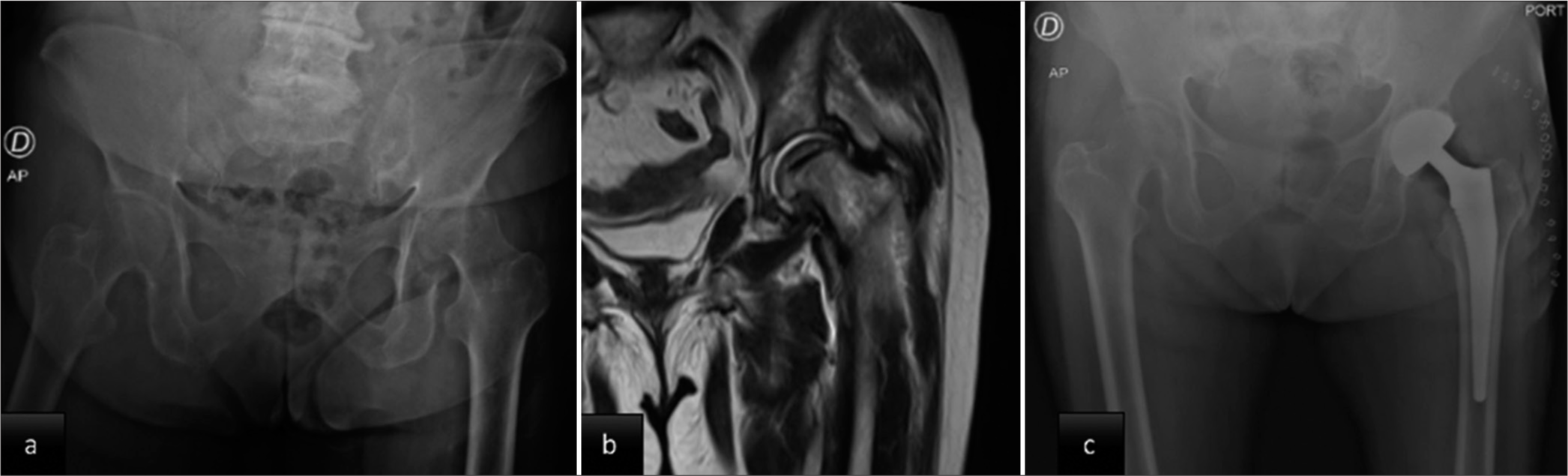 Bilateral hip ochronosis, an unsuspected diagnosis in polyarticular pain: A case report