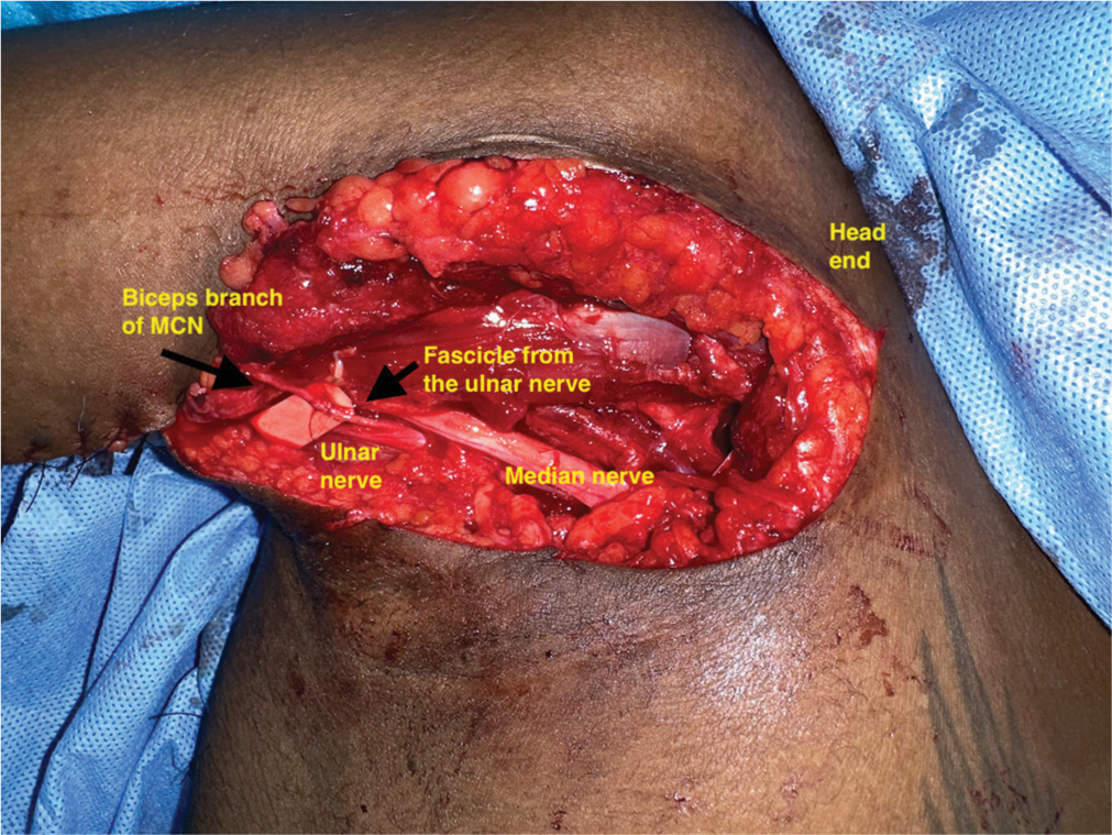 Ultrasound to guide nerve transfer healing and muscle re-innervation