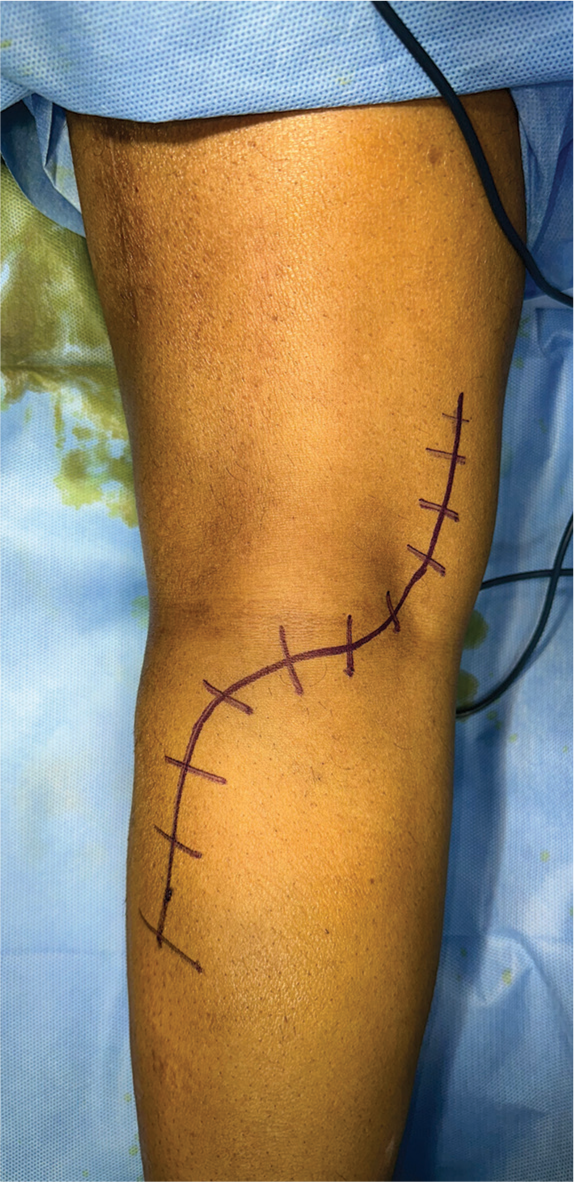 Combined distal tibial nerve transfer and tibialis posterior tendon transfer for foot drop correction: A surgical technique and case illustration