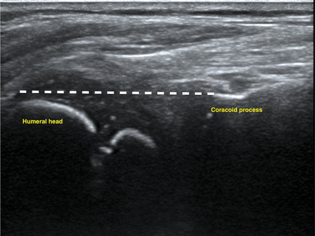 Anterior ultrasound approach for evaluating posterior shoulder instability in brachial plexus birth palsy: A novel diagnostic technique