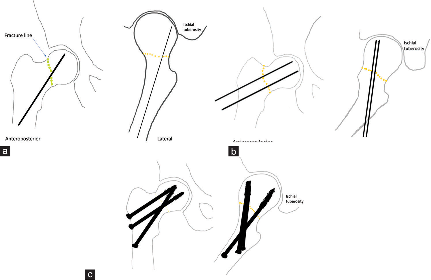 Challenges of biplane double-supported screw fixation technique for osteosynthesis of femoral neck fractures in the South Indian population