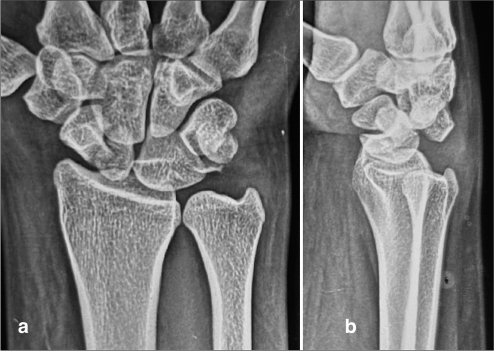 Neglected perilunate injuries: Management strategies and long-term consequences: A narrative review