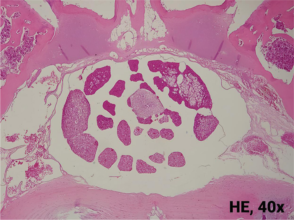 Effectiveness of autologous fat graft and methylprednisolone as single and combination therapy in the prevention of epidural fibrosis