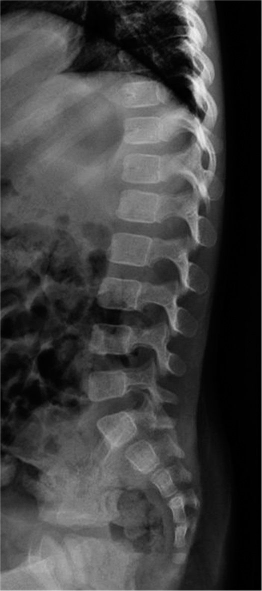 A rare case of infective spondylodiscitis in an 18-month-old infant: Clinical presentation and management
