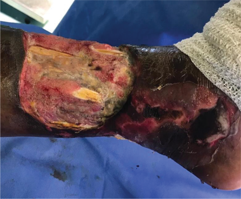 Successful use of platelet-rich plasma as a regeneration technique for a non-healing diabetic leg ulcer with chronic osteomyelitis: A case report