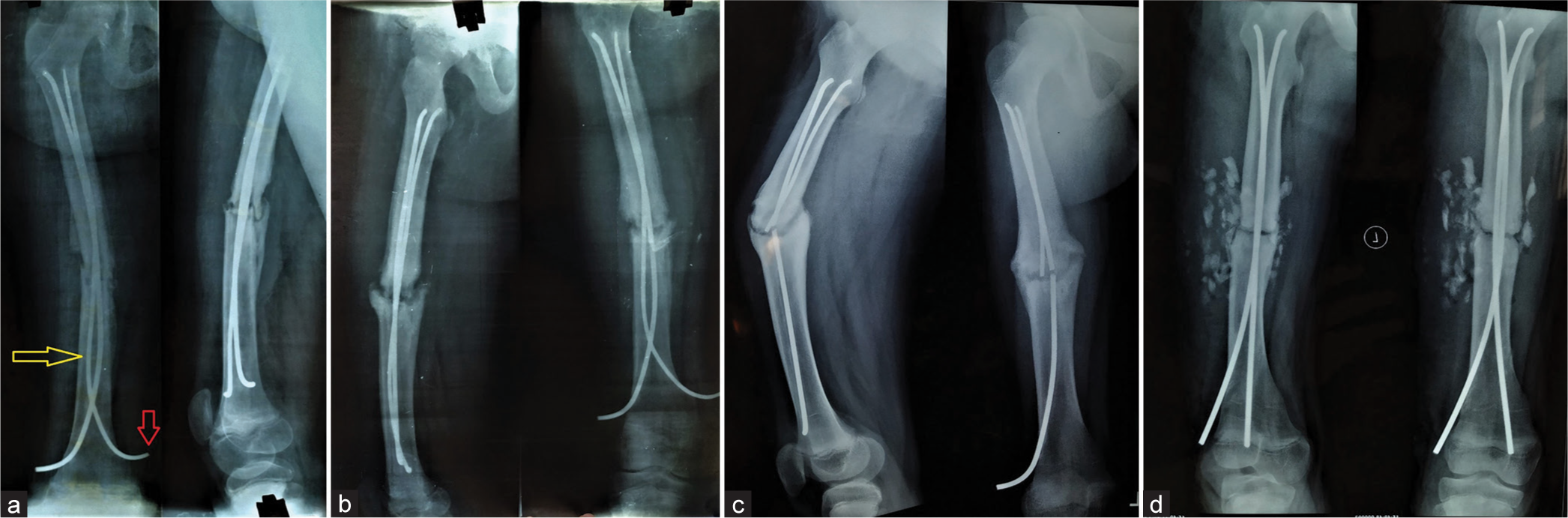 Instability, non-union, and subsequent failure of flexible nails: Takeaways from the complication