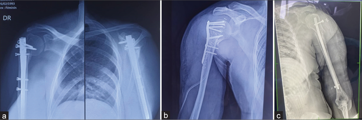 An audit of treatment of proximal humerus fractures type 3 and 4 of Neer classification in a resource-poor setting in Sub-Saharan Africa