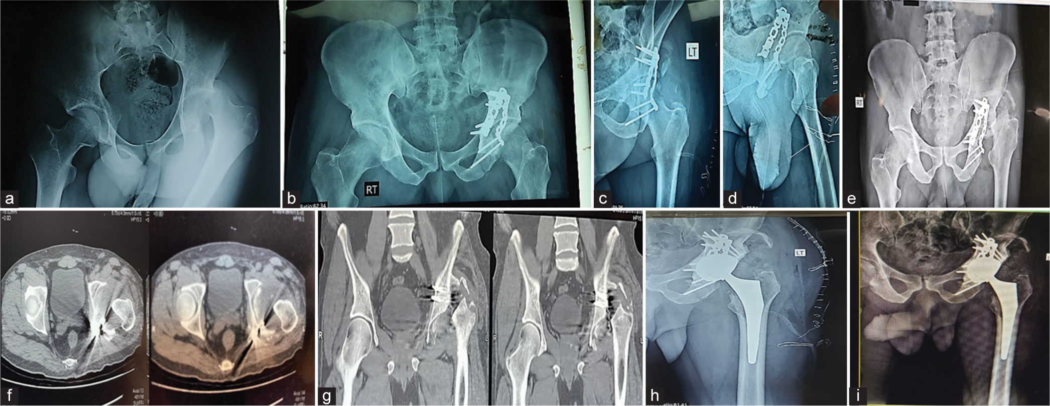 Evaluation of total hip arthroplasty for management of acetabular fracture complications: A prospective cohort study