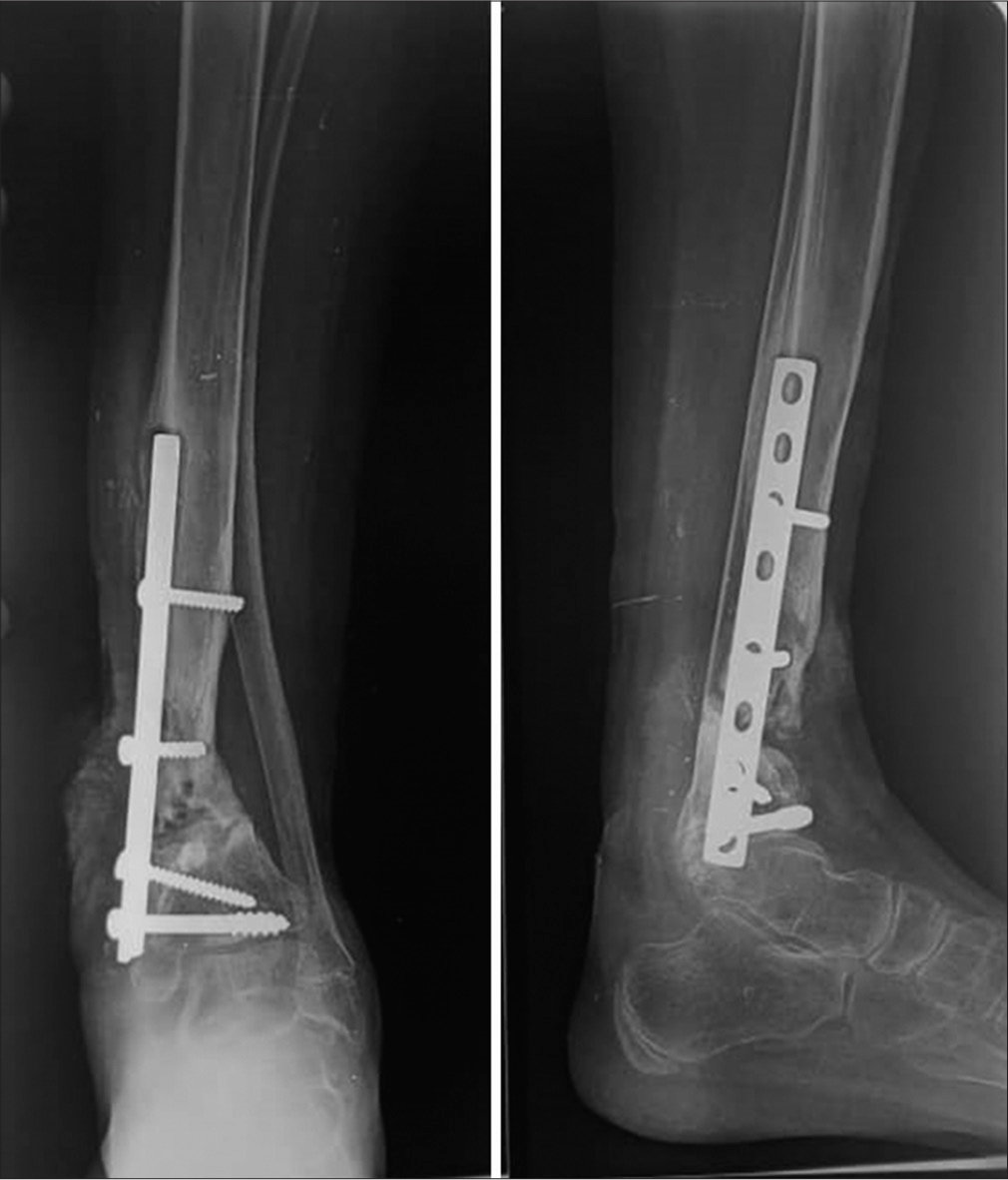 Management of closed diaphyseal fractures in children in two black African countries: Preliminary results and epidemiological profile