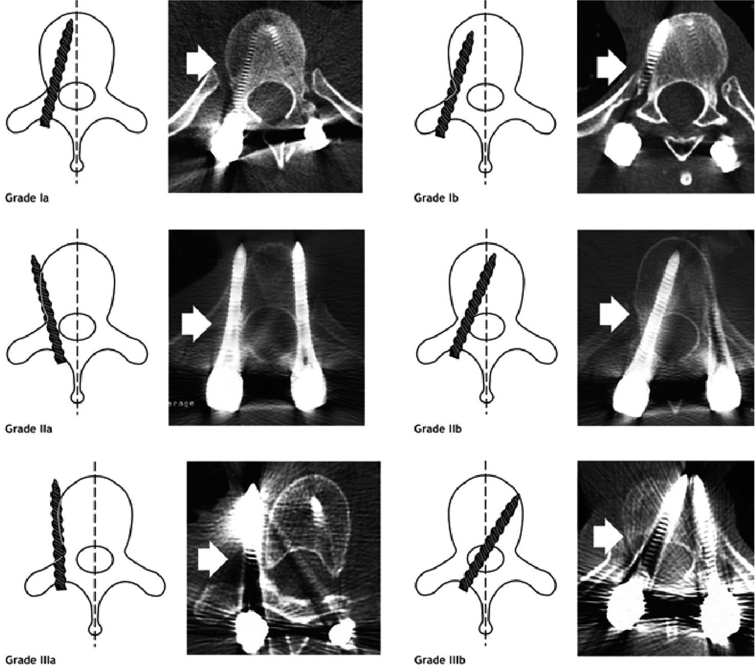 The accuracy of intraoperative O-arm imaging in assessing thoracolumbar pedicle screws placement