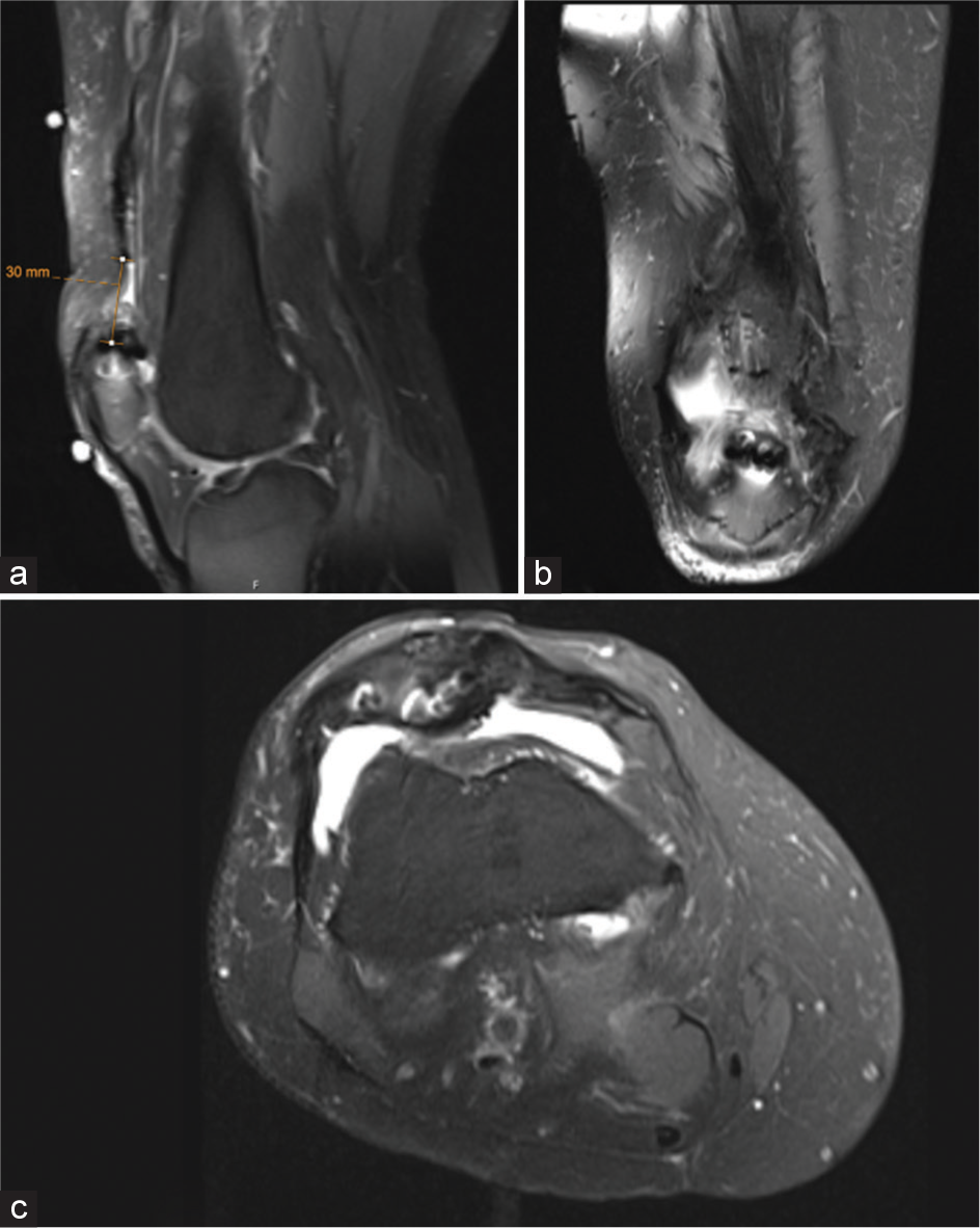 Technique for revision reconstruction of a chronic quadriceps tendon re-rupture using Achilles tendon allograft