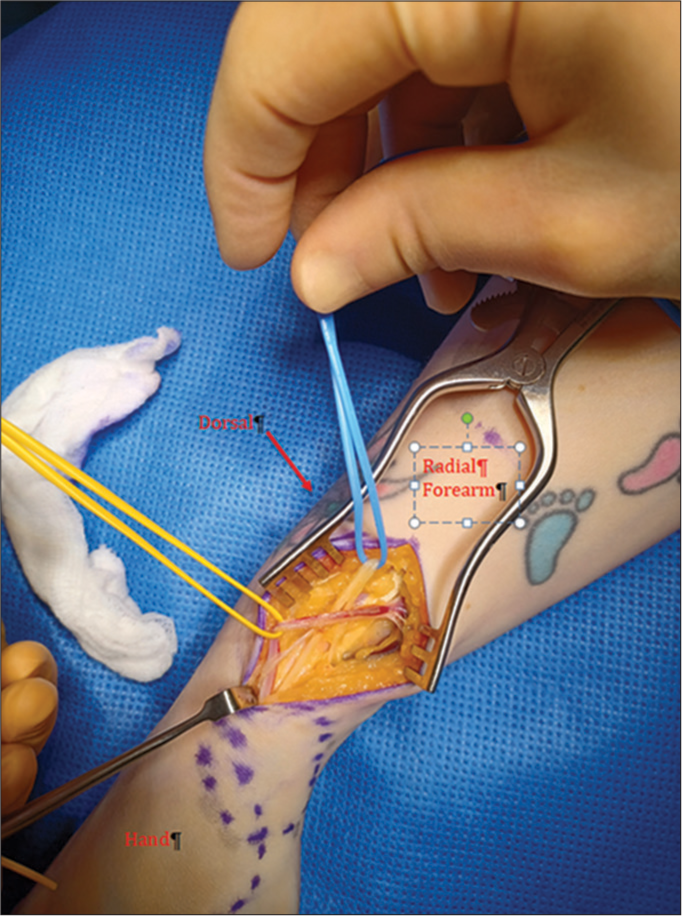 Wartenberg’s syndrome – A unique presentation resulting from compression of the superficial radial nerve from an anomalous radial artery branch