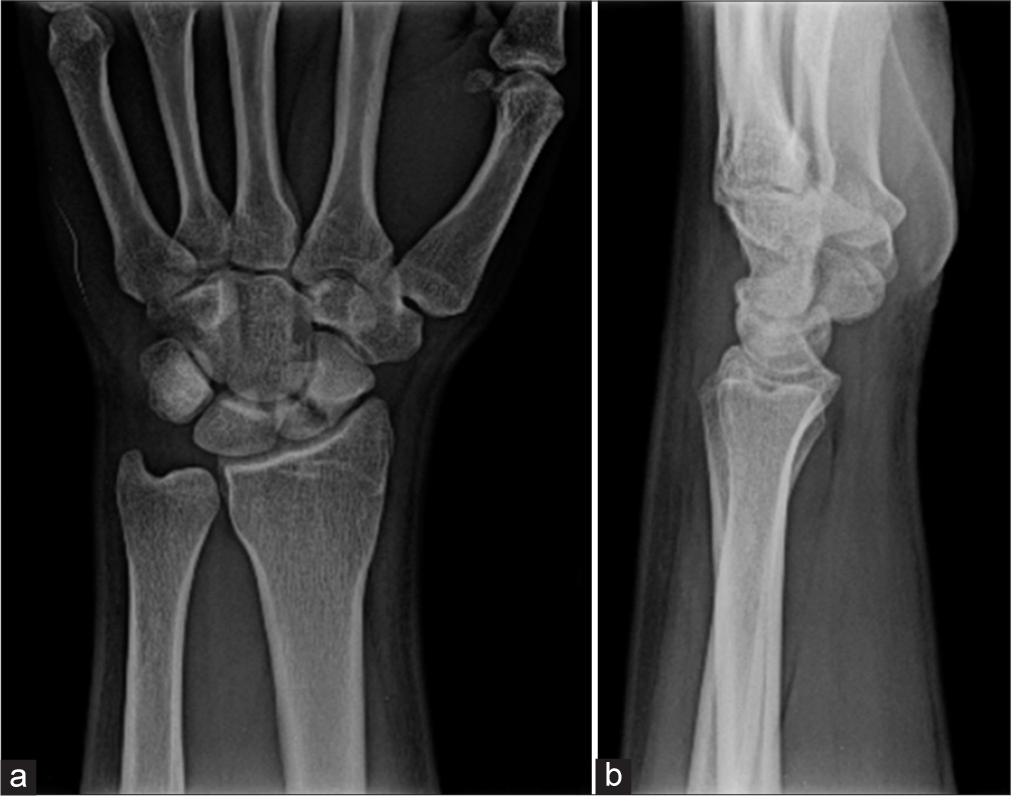 Spontaneous union of neglected proximal pole scaphoid fracture: A case report