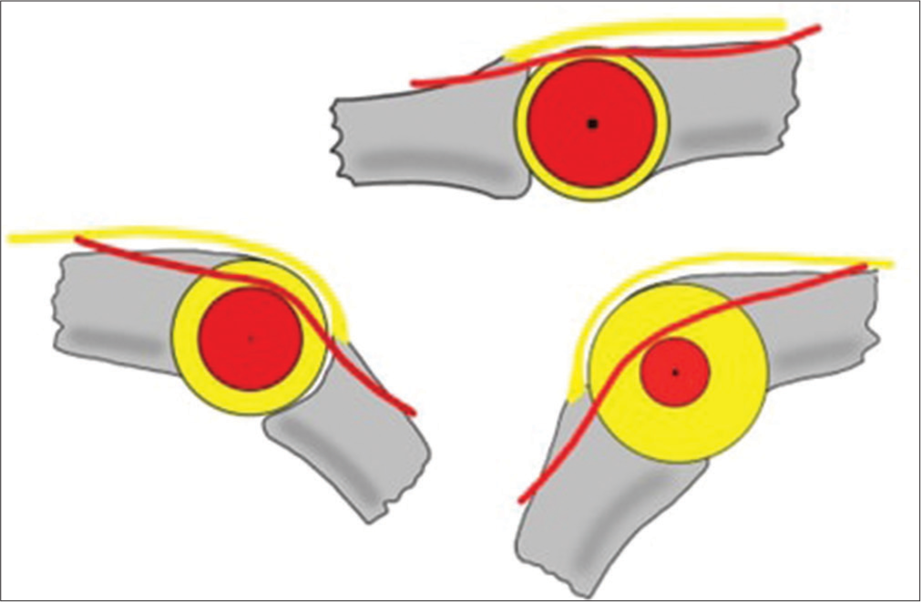 Progression and clinical implications of boutonniere deformity