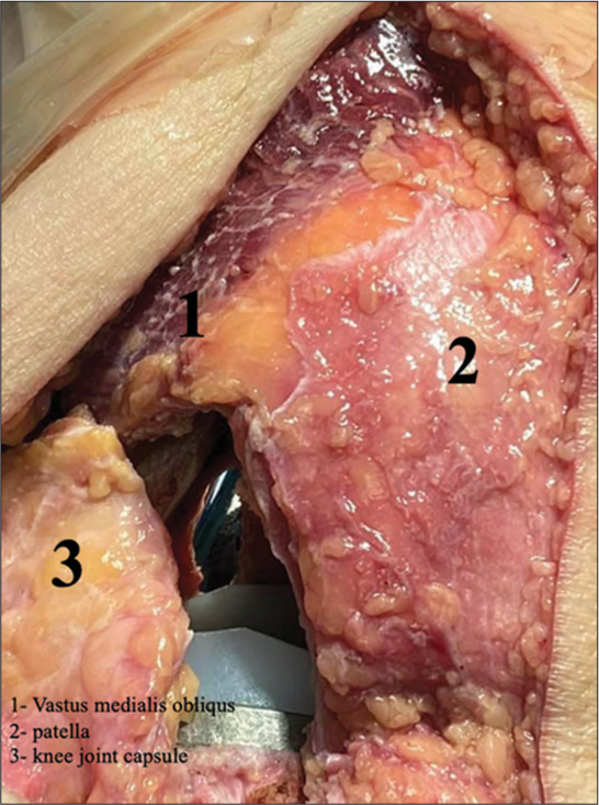 Subvastus approach improves intraoperative patellofemoral tracking in total knee arthroplasty for varus deformities – An in vivo study