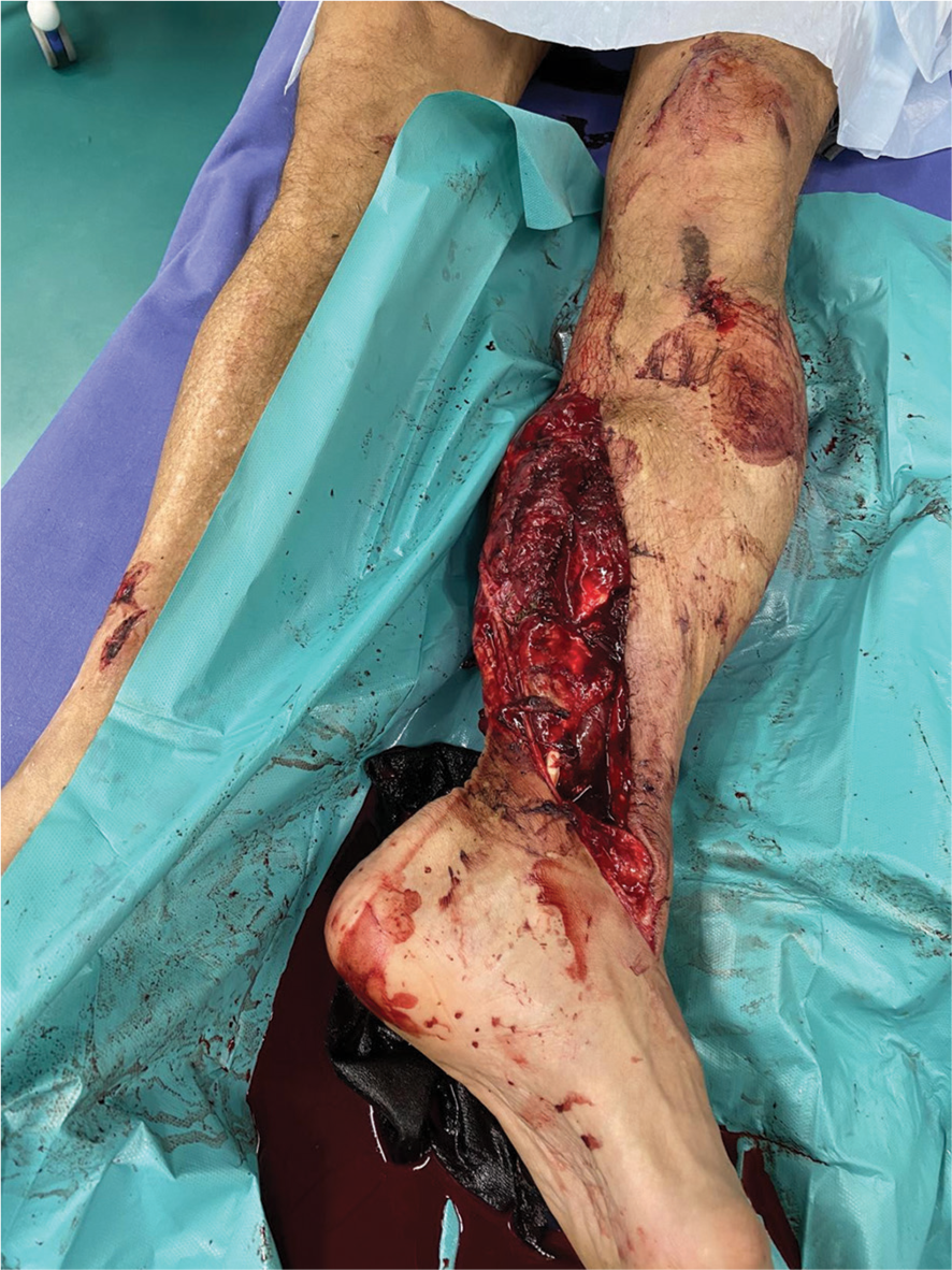 Massive bone defect in open leg fracture: A case report