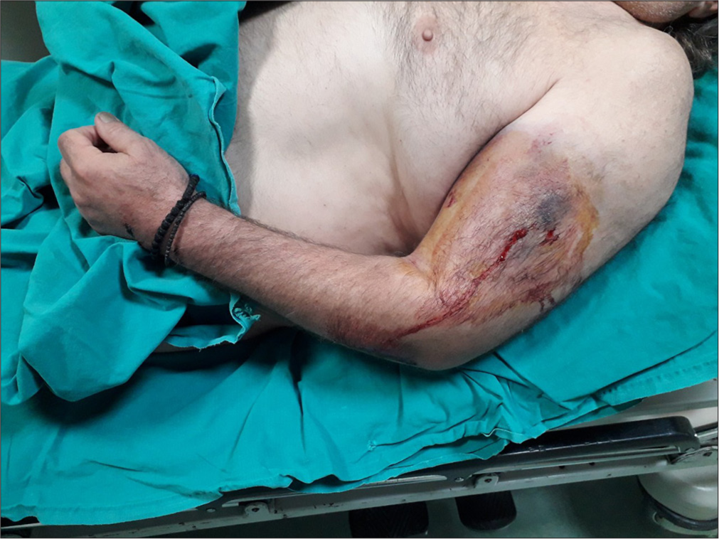 Compartment syndrome of the upper arm following a blunt injury: A case report