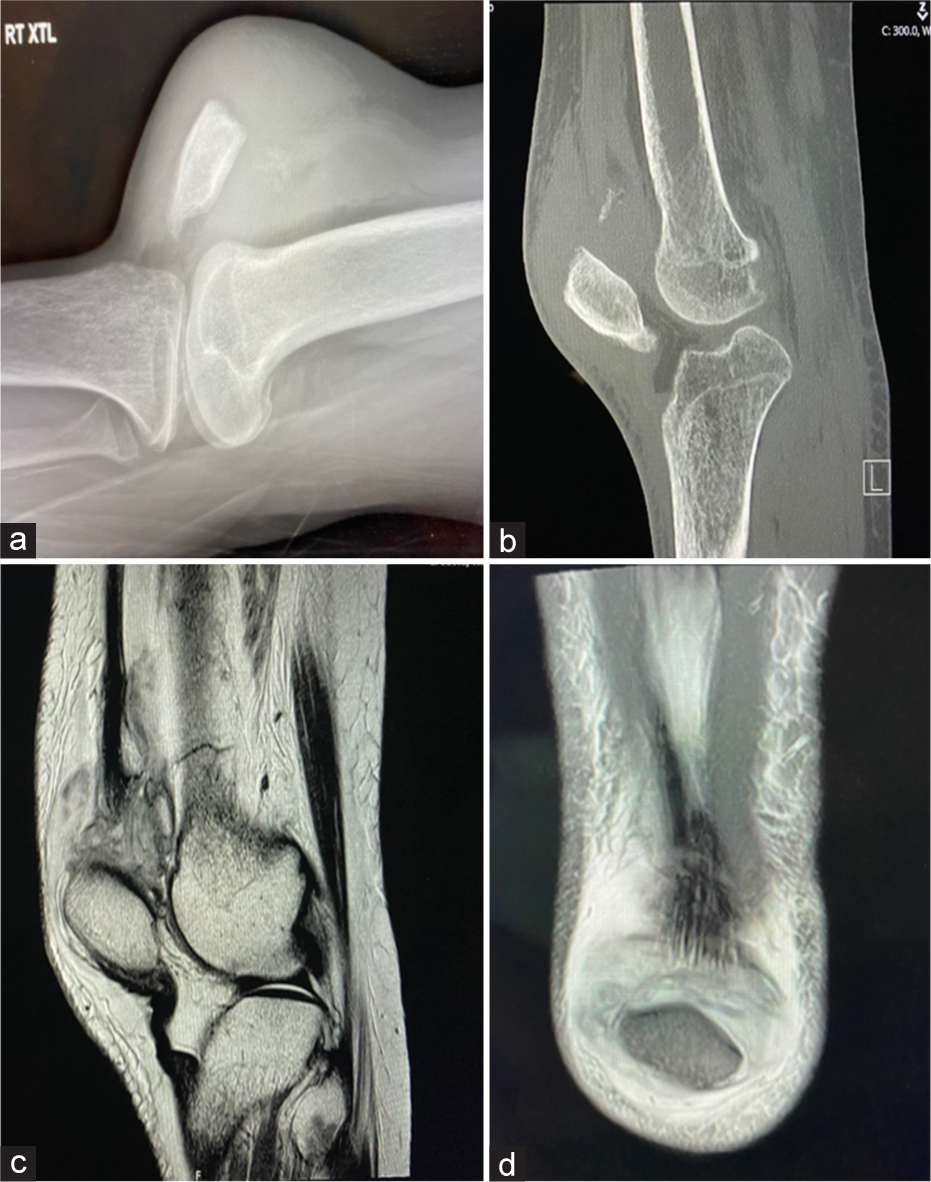 Bilateral triceps and unilateral quadriceps tendon rupture in a patient with end-stage renal disease: A case report and review of literature