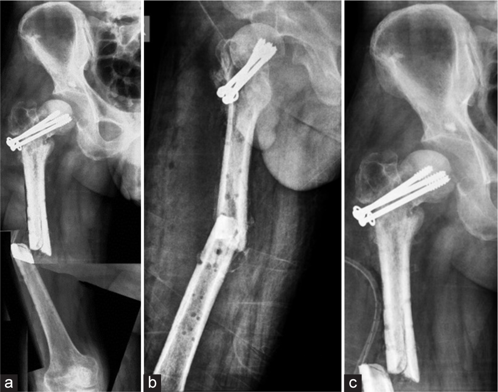 Staged total hip arthroplasty using a handmade articulating spacer to manage bifocal-infected non-united femoral shaft and neck fractures. A case report and technical note