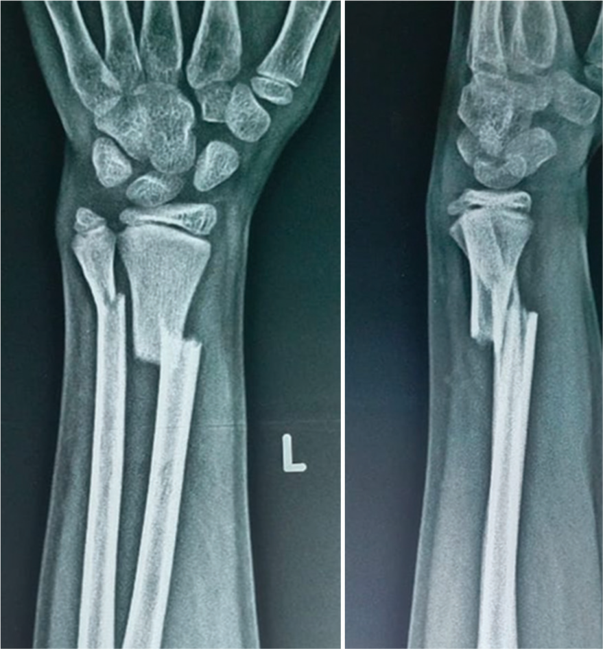 Combined intrafocal K-wire pinning for unstable pediatric distal forearm fractures