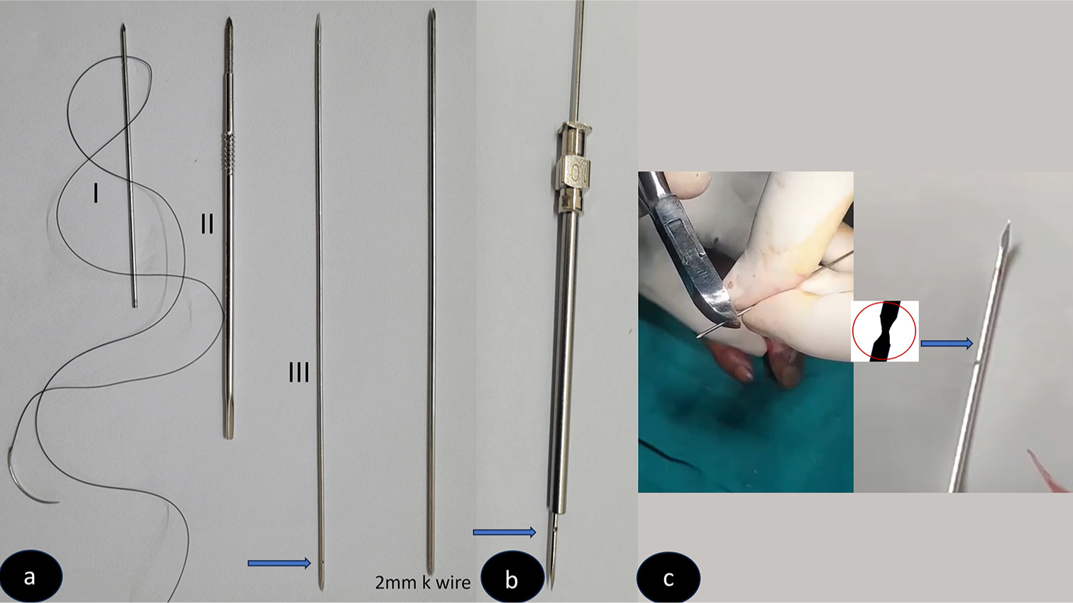 Innovative modifications in the K-wires: A boon for resource-constrained orthopedic hospitals