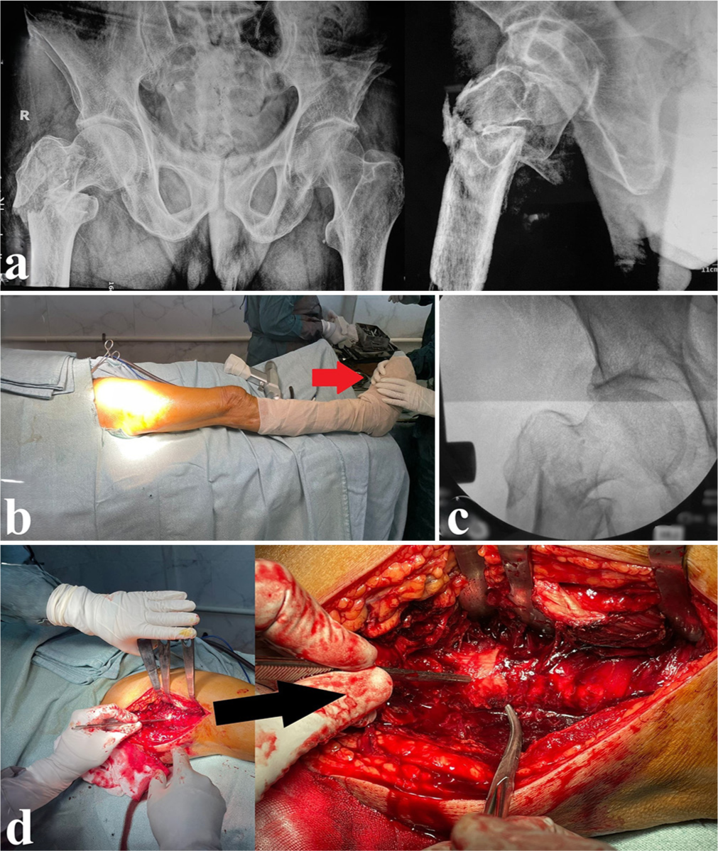 Narrow DCP application during intertrochanteric fracture fixation to serve as a fracture reduction maintenance tool and a trochanteric stabilization plate