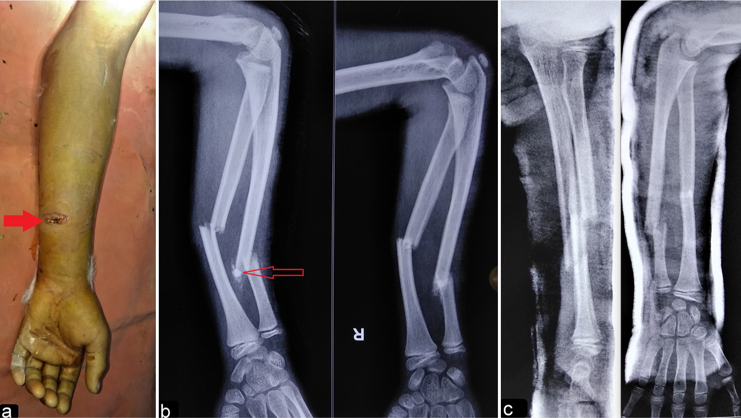 Debridement, antibiotics, and implant retention in a fracture-related infection with flexible forearm nail in situ: A case report of a successful outcome in an adolescent