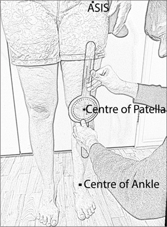 The reliability of goniometric measurement of frontal knee alignment in standing in people with knee osteoarthritis: A pilot study