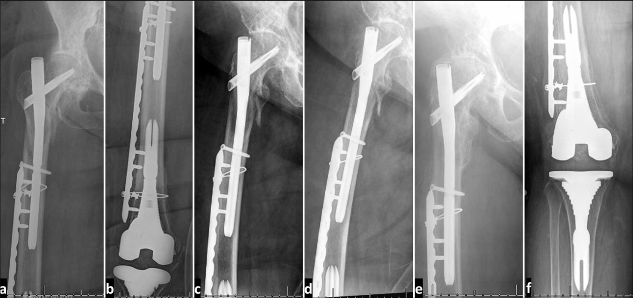 Low trochanteric fractures in the presence of knee arthroplasty: The role of intermediate length cephalomedullary nail