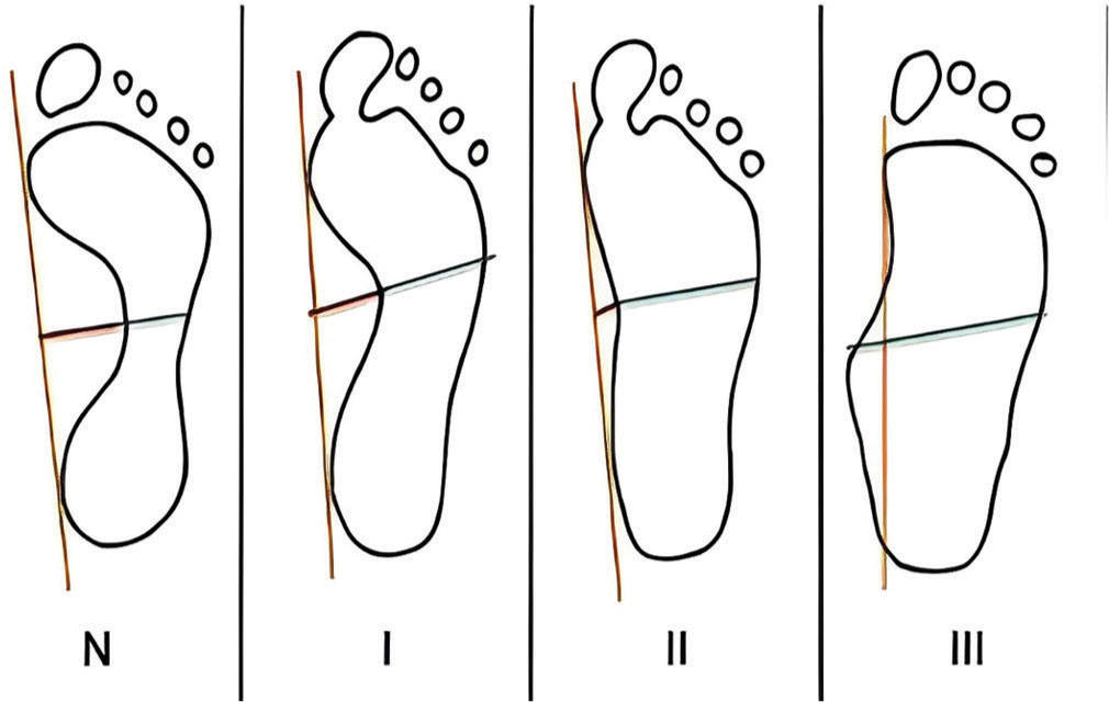 Surgical treatment of flexible flatfoot in adolescents: Sinotarsic endorthesis